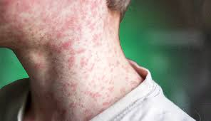 South Carolina Measles Outbreak Intensifies as Cases Continue to Climb